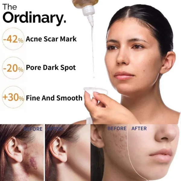 ordinary peeling serum uneven skin blemish korean the ordinary, glycolic acid 7%, toning solution, toner, exfoliator